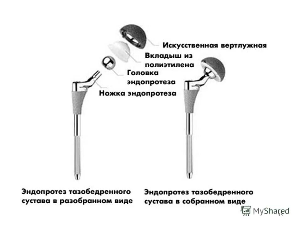 Тэп сустава. Составные части эндопротеза тазобедренного сустава. Эндопротезирование тазобедренного сустава DEPUY. Эндопротез тазобедренного сустава цементной фиксации. Строение эндопротеза тазобедренного сустава.