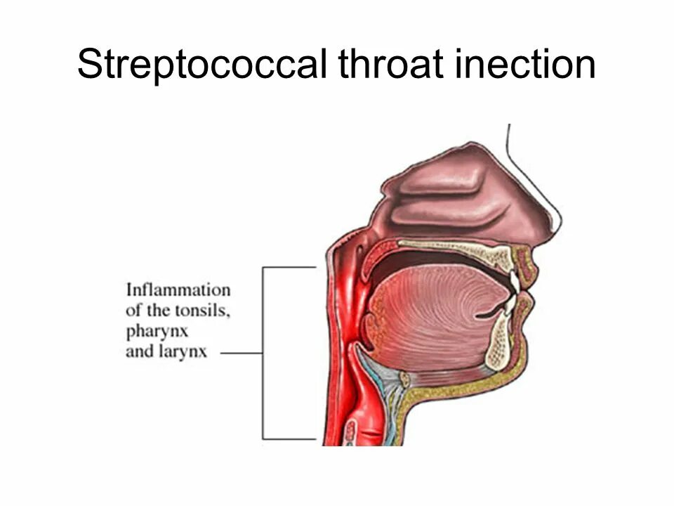 Воспаление стенки гортани. Задняя стенка носоглотки. Глотка резиновый