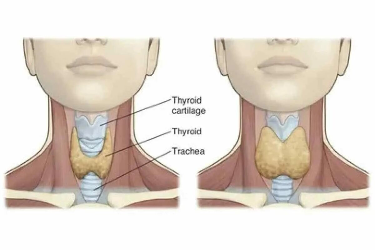 Изменение щитовидной железы у ребенка. Щитовидный хрящ и щитовидка. Кадык и щитовидная железа. Диффузный эутиреоидный зоб.