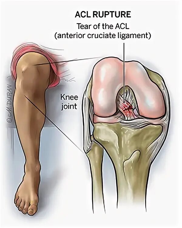 Anterior cruciate ligament reconstruction. Acl это. Расширенный acl структура. Разрыв пкс коленного сустава. Повреждения 1 степени крестообразной связки.
