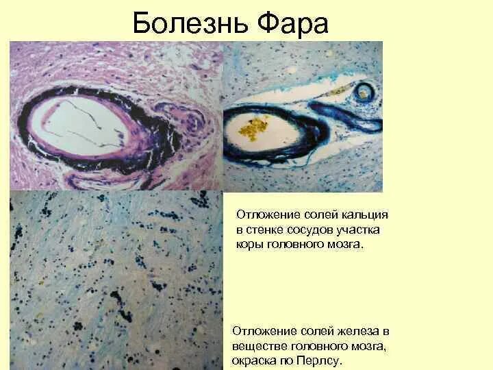 Отложение кальция. Отложение солей кальция микропрепарат. отложение кальциевых солей.