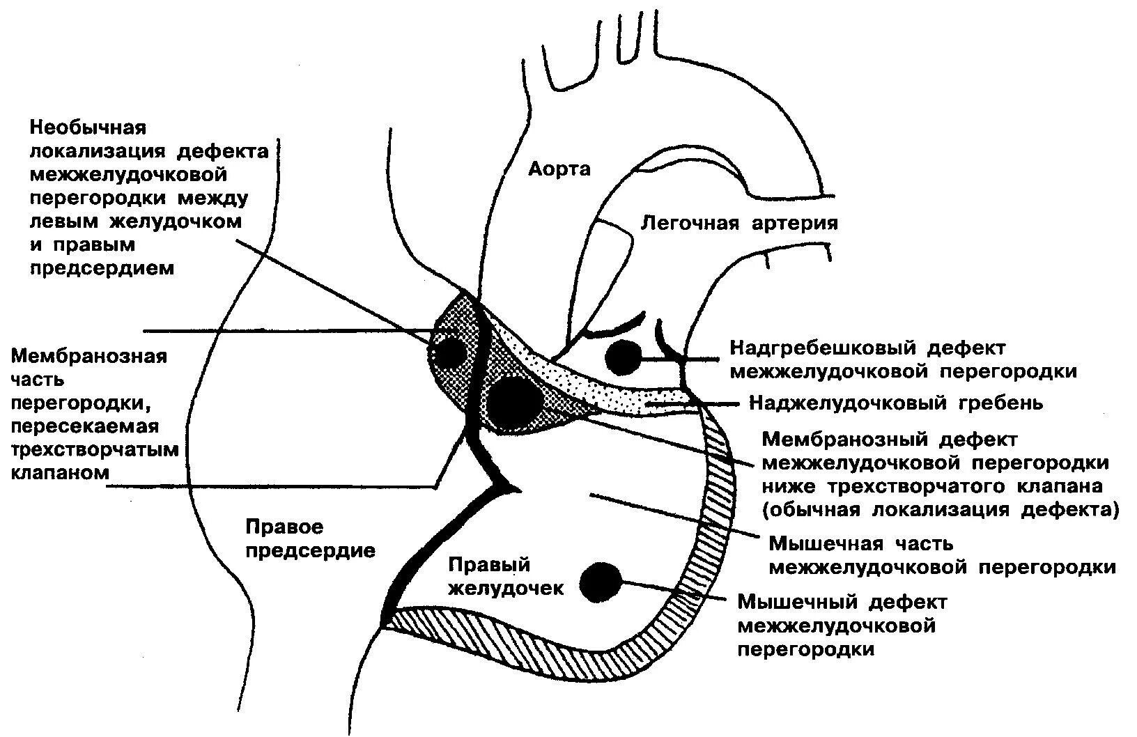 Часть ба. Дефект мембранозной части межжелудочковой перегородки. Типы дефектов межжелудочковой перегородки. Инфундибулярный Тип, ДМЖП. Дефект межжелудочковой перегородки локализация.