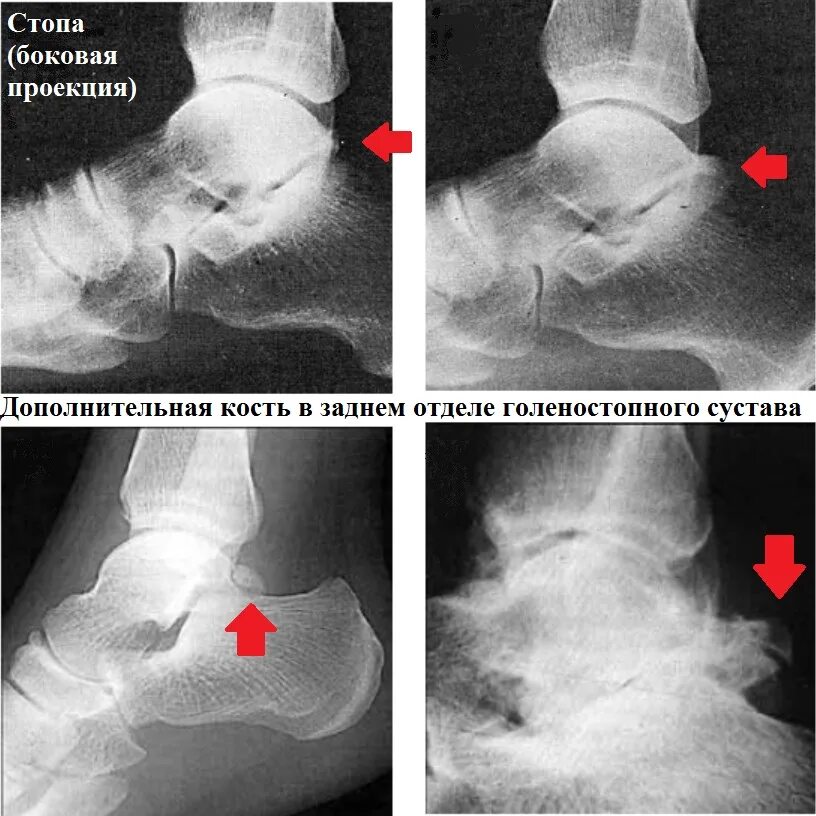 Синдромы голеностопного сустава. Таранная кость сустав. Таранная кость стопы рентген. Голеностопный сустав в боковой проекции. Сесамовидная кость голеностопного сустава.
