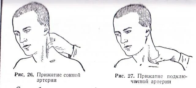 Пальцевое прижатие височной артерии. Пальцевое прижатие сонной артерии. Пальцевое прижатие наружной челюстной артерии. Пальцевое прижатие при кровотечении из сонной артерии. Сонная артерия как нащупать где