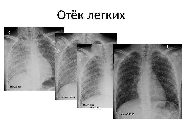 Отек легких симптомы у взрослых. Отек легких симптомы у взрослых