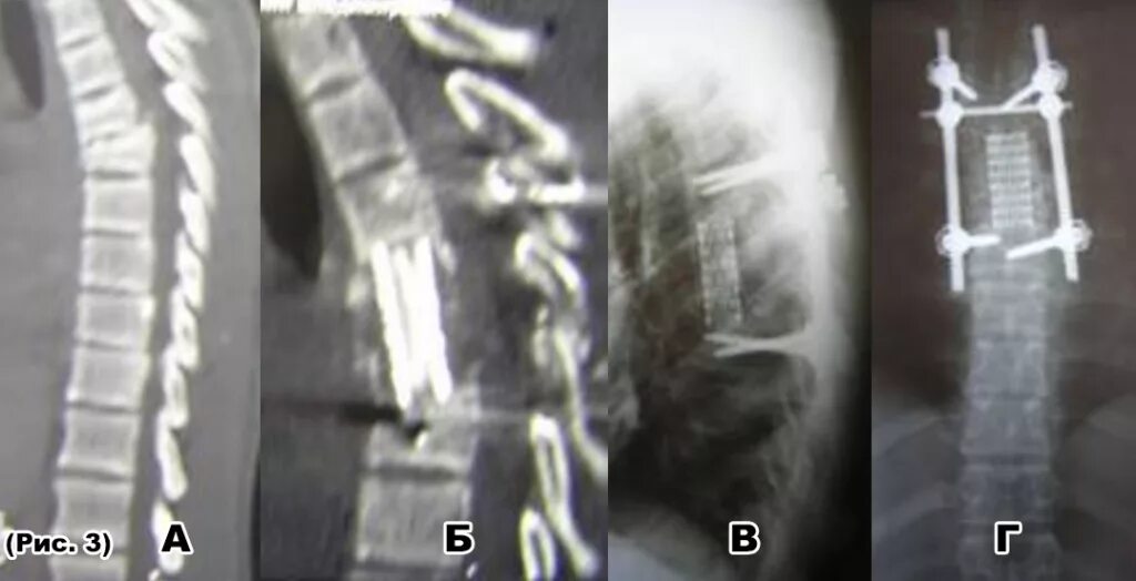 Компрессионный перелом th6 позвонка. Компрессионный перелом позвоночника th6 th7. Компрессионный перелом th4,th5 позвонков.