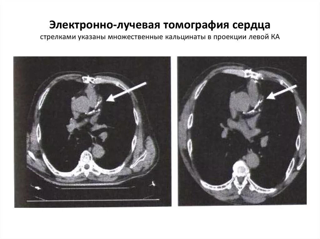 Кальциноз коронарных артерий на кт. Кальциноз митрального клапана на кт. Электронно-лучевая томография. Электронно лучевая кт.