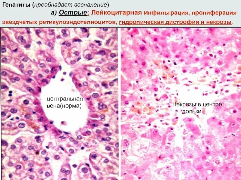 Токсическая дистрофия печени. Гидропическая дистрофия. Дистрофия гепатоцитов гистология. Гидропическая дистрофия печени. Баллонная дистрофия гепатоцитов.