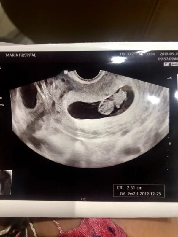 Compilation 9 weeks 2 days Ultrasound - YouTube