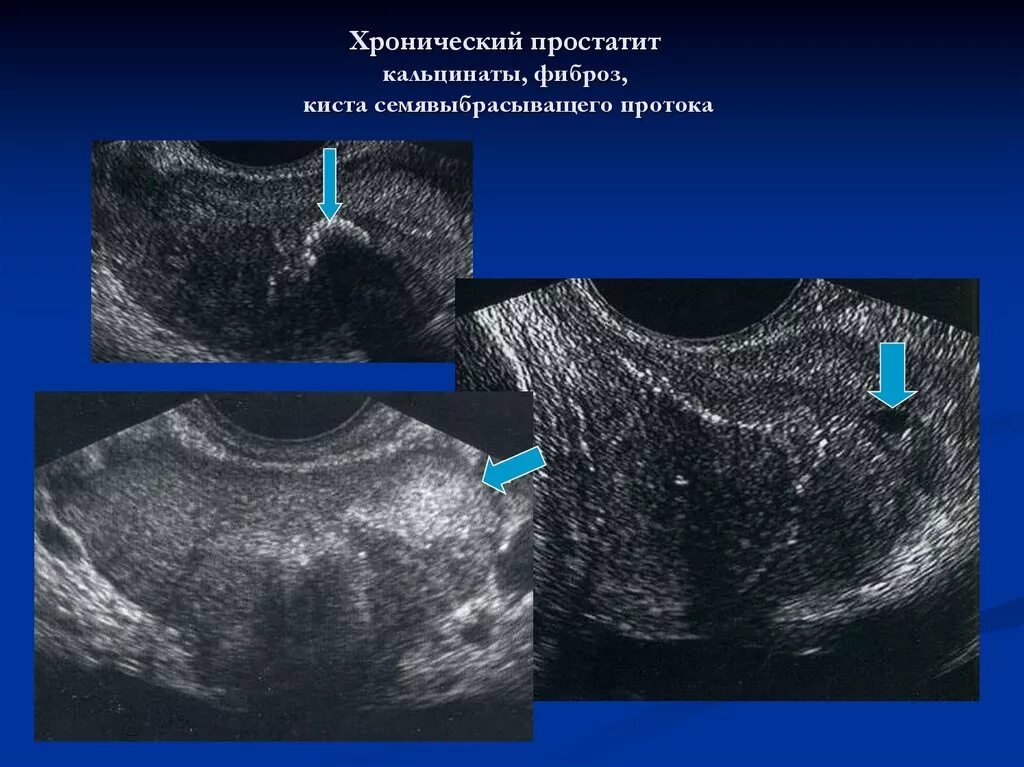 Хронический простатит предстательной железы. Кальцинаты в предстательной железе УЗИ. Кальцинат в простате на УЗИ. Фиброз предстательной железы на УЗИ. Хронический простатит на УЗИ.