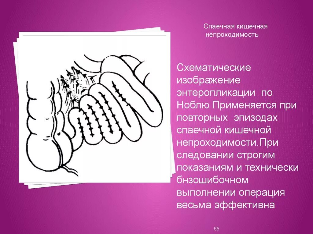 Операция непроходимость. Спаечная кишечная непроходимость. кишечная непроходимость спайки. спайки при кишечной непроходимости. кишечная непроходимость операция.