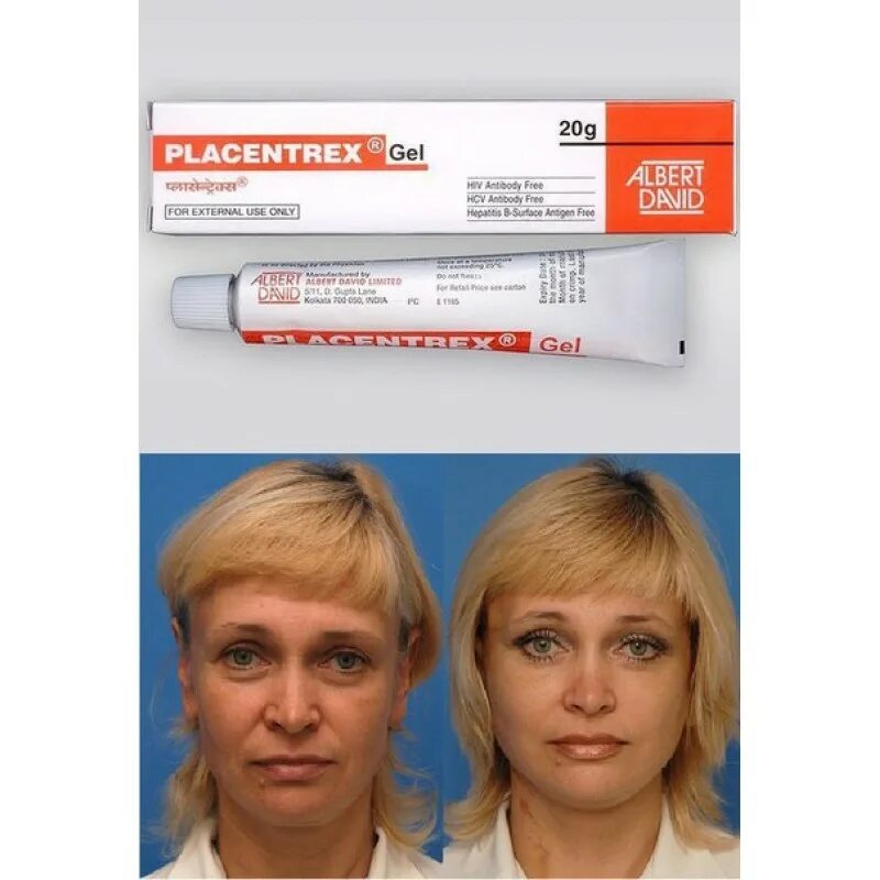 Плацентарный гель купить. Placentrex крем и гель. Плацентрекс гель от морщин. Плацентарный гель от витилиго.