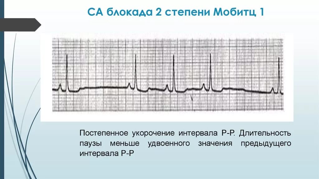 Са блокада 2 тип. Синоатриальная блокада Мобитц 1 ЭКГ. Са блокада 2 степени Мобиц. Са-блокада II степени, Тип 2 (Мобитц 2). Синоатриальная блокада 2 степени на ЭКГ.