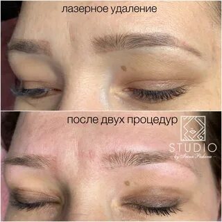 Можно ли после лазерной