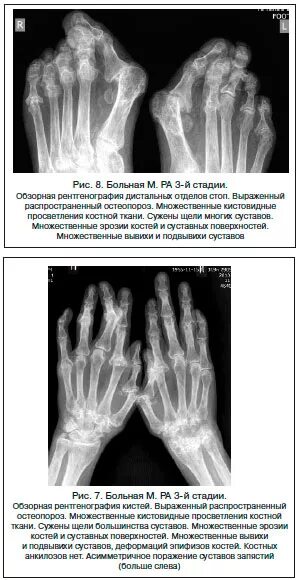 Артрит рентгенологические стадии. Рентген критерии ревматоидного артрита. Рентген суставов псориатический артрит. Ревматоидный артрит 1 степени рентген. Ревматоидный артрит рентгенологическая стадия III.