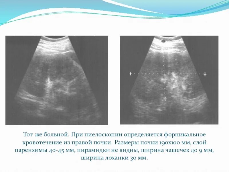 Паренхима почки что это. Толщина паренхимы почки. Киста паренхимы почки УЗИ. Киста паренхимы правой почки что это такое.