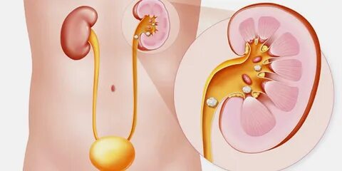 sprühen Opfer Lokomotive nierensteine ernährung Herr Lotus Greifen