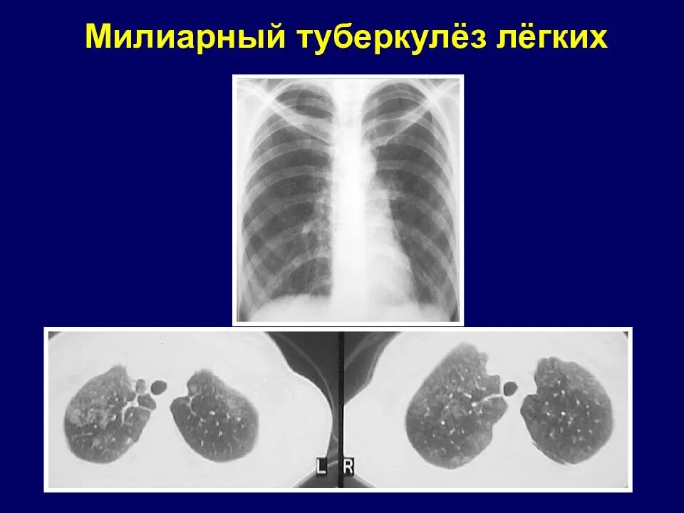 Внутренний туберкулез. Острый милиарный диссеминированный туберкулез. Гематогенно- диссеминированный туберкулез (милиарный). Острый милиарный туберкулез легочной формы. 6. Милиарный туберкулез легких..