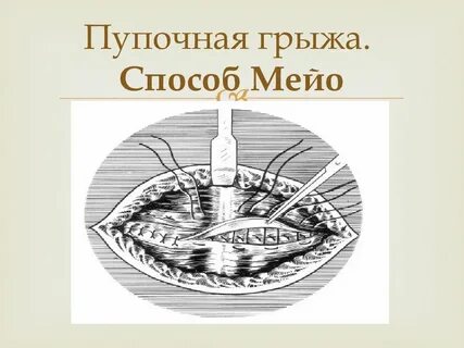 Пупочная герниопластика