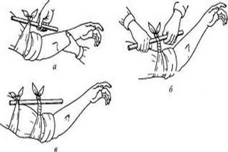 Давящая повязка при кровотечении время. Венозное кровотечение перевязка. Перевязка артерии жгутом. Перевязка артериального кровотечения. Перевязка при артериальном кровотечении руки.