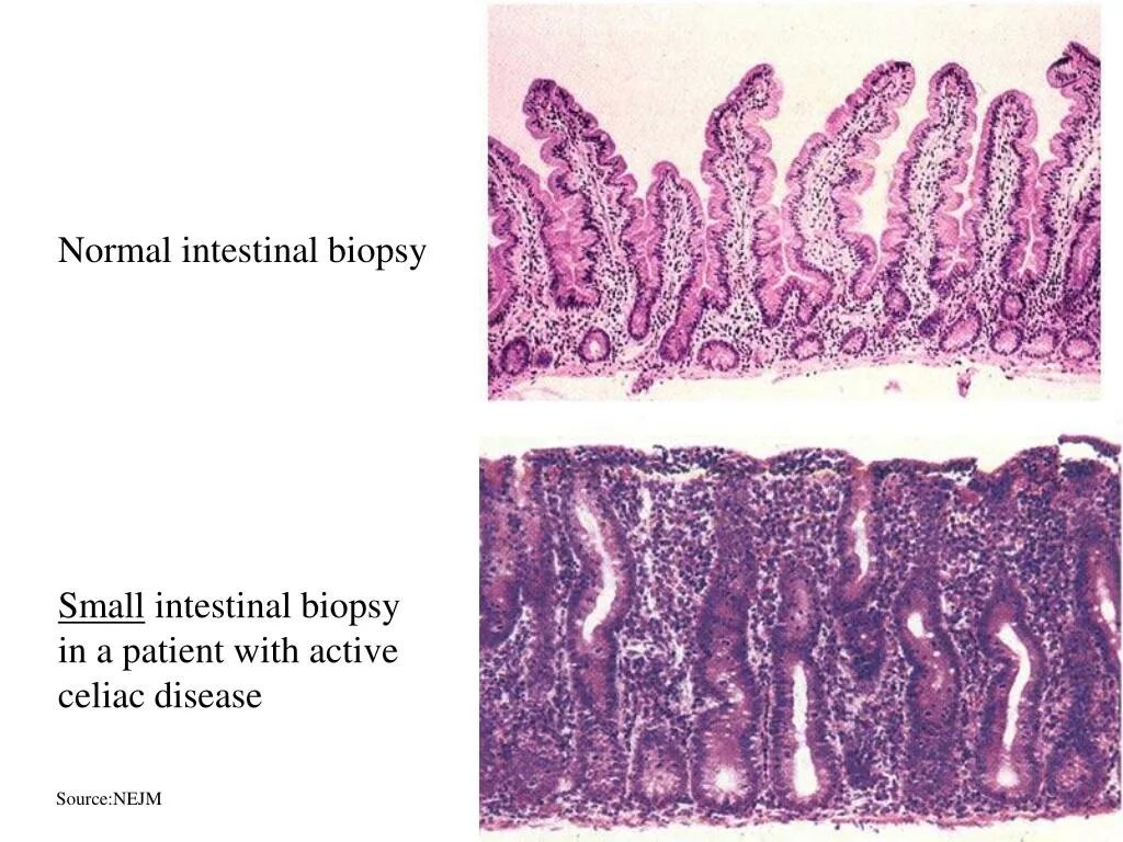 Биоптат кишки. Целиакия гистология кишечника. Эндоскопическая щипцовая биопсия кишечника. Целиакия гистологическая картина.