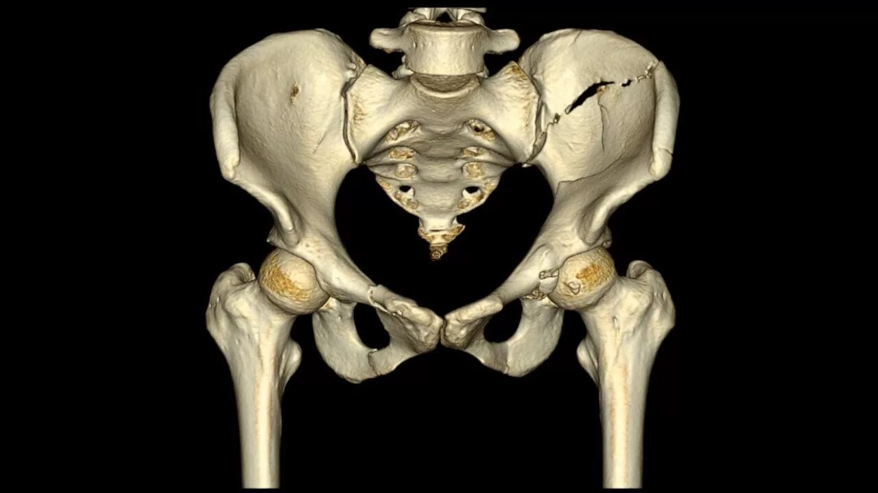Изменения костей таза. Лобковая кость анатомия на скелете. Тазовая кость. Тазобедренные кости. Кости таза женщины.