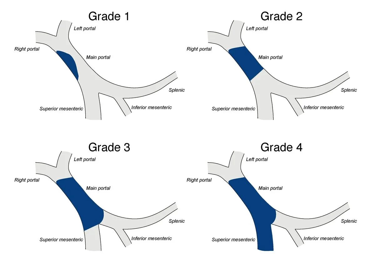 Тромбоз воротной вены на кт. Классификация тромбоза воротной вены по Yerdel. Тромбоз печеночной вены кт. Тромбоз вены печени