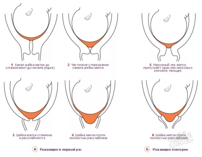 Схема раскрытия шейки матки. Этапы раскрытия шейки матки. Шейка матки перед родами. Сглаживание шейки матки.