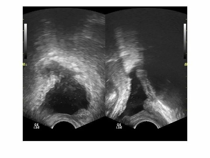 Семенные пузырьки на трузи. Семенной бугорок на трузи. Семенные пузырьки на трузи везикулита. Хронический простатит на УЗИ. Нарушение предстательной железы