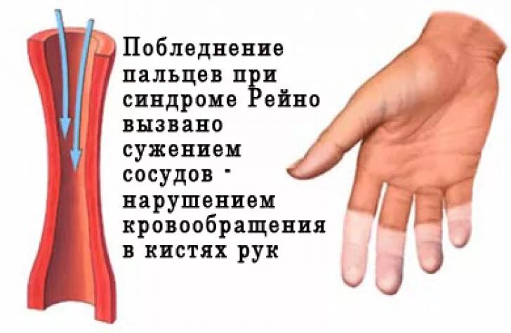 Сужение сосудов руки. Ангиоспастический синдром Рейно. Вибрационная болезнь синдром Рейно. Болезнь Рейно симпатэктомия. Нарушение кровообращения в руках.