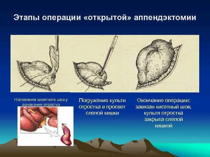 Аппендэктомия ход операции. Антеградная аппендэктомия аппендэктомия. Типичная аппендэктомия ход операции. Показания к операции аппендэктомия.