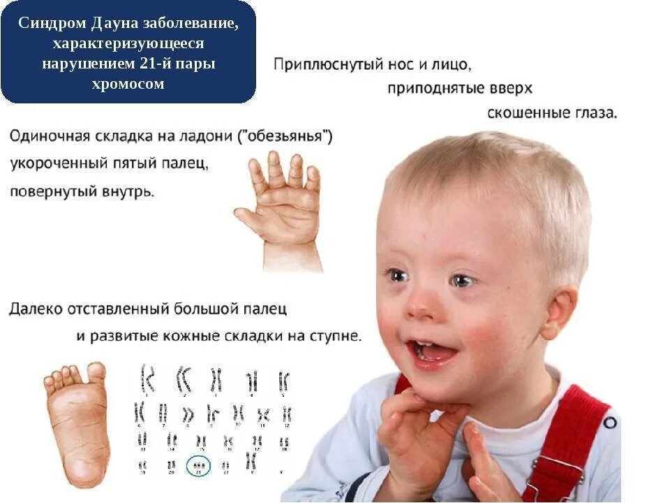 Есть ли ковид у детей. Признаки синдрома дауна у новорожденного ребенка в 1год. синдром дауна симптомы характер нарушений. ушные раковины у детей с синдромом дауна. признаки синдромома дауна.