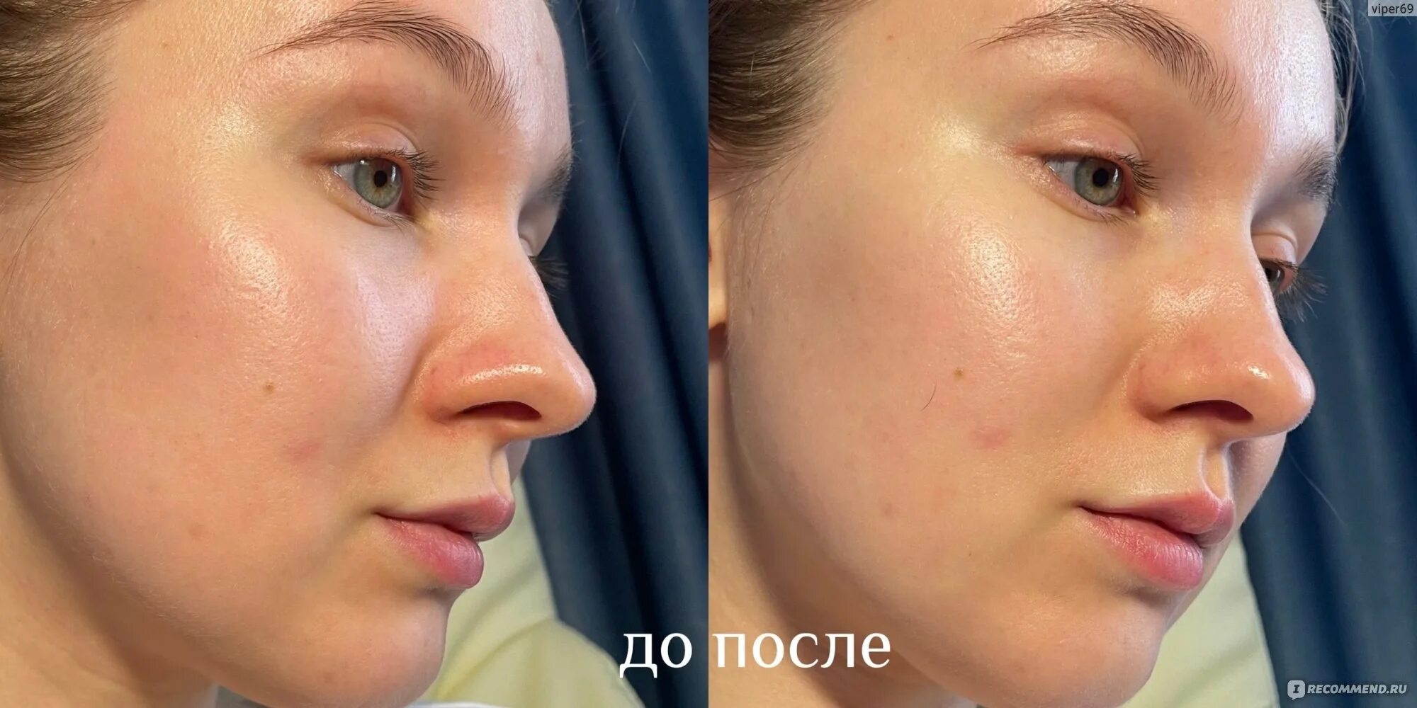Neulii niacinamide 10. Neulii niacinamide 10