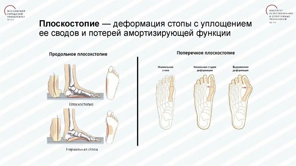 Свод стопы лечение
