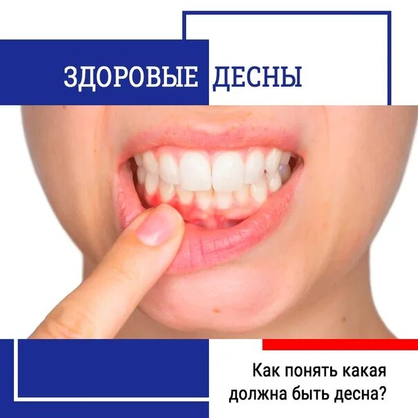 Как должны выглядеть десны Имплантация при пародонтозе и пародонтите Хирургическая стоматология