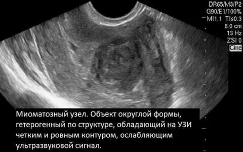 Узел стенке матки