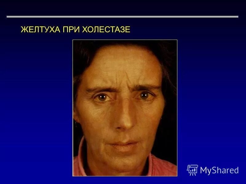 желтушный период гепатита в. желтуха у взрослых детей. цирроз печени симптомы желтухи. тип желтухи при вирусном гепатите. вирусный гепатит симптомы.