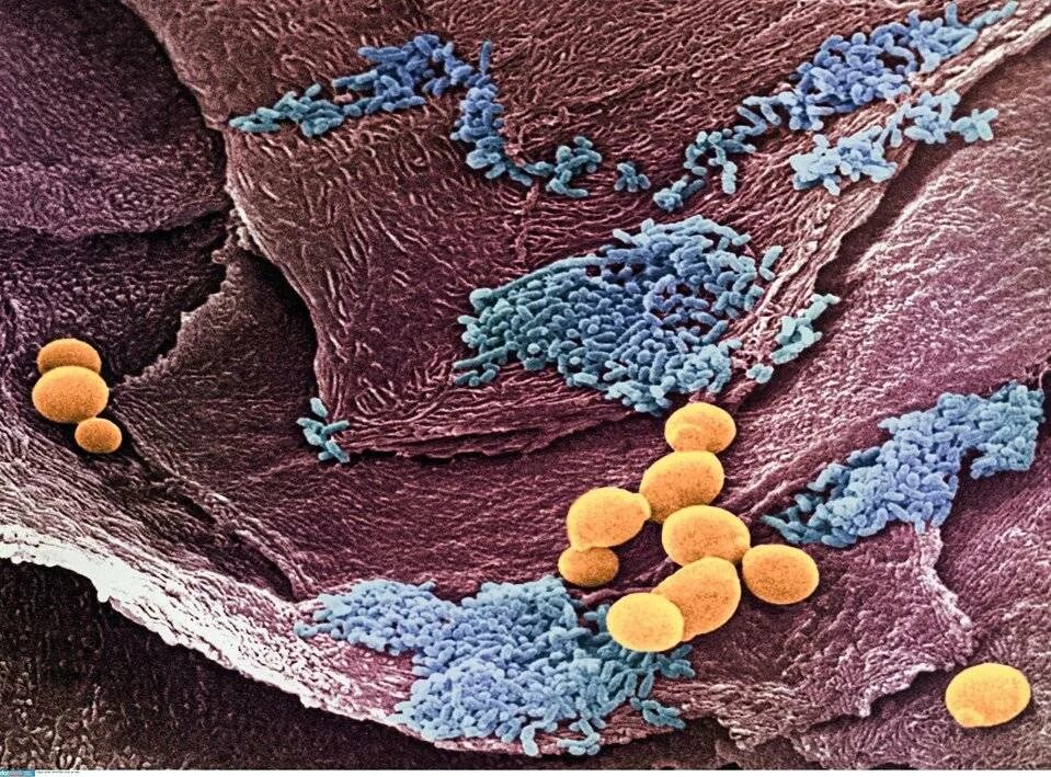 Молочница гриб. Висцеральный кандидамикоз. Что такое грибковая инфекция Candida.