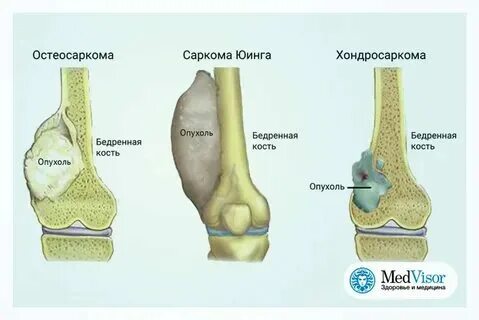 Как выглядит рак колена Рак костей и суставов