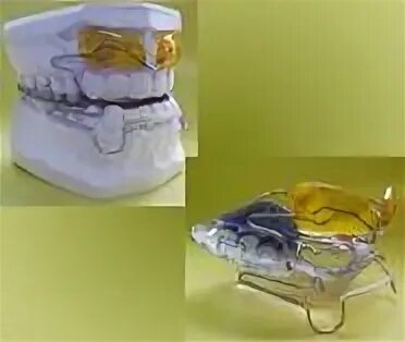 Открытый активатор кламмта. Открытый активатор кламмта. Андрезена гойпля. Андрезена гойпля. Активатор андрезена гойпля ортодонтия.