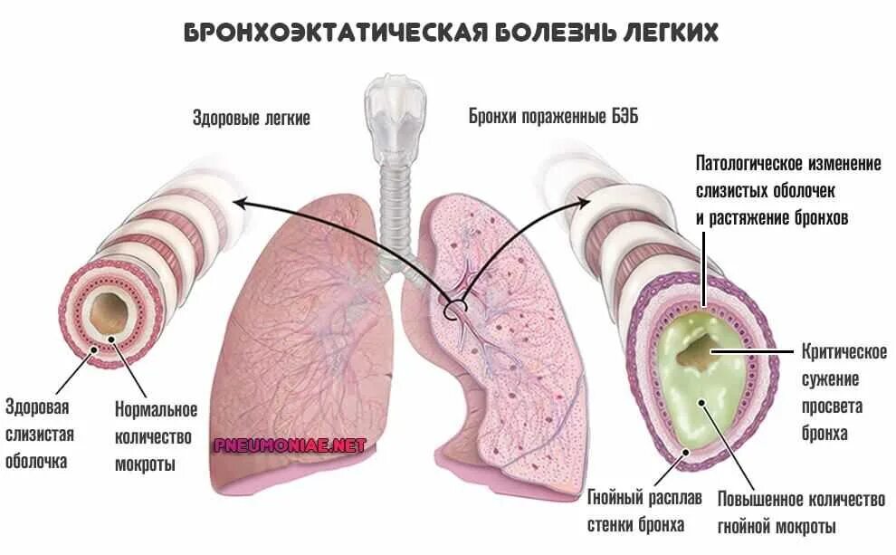 Бронхит бронхоэктатическая болезнь. Бронхоэктатическая болезнь легких патогенез. Бронхоэктатическая болезнь вид мокроты. Бронхоэктатической болезни мокрота. Этиология бронхоэктатической болезни легких.