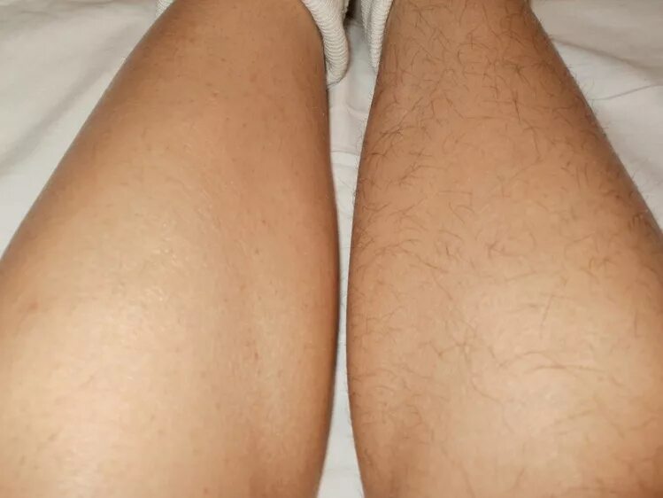 Эпиляция после бритья. Депиляция ног. Шугаринг ног.
