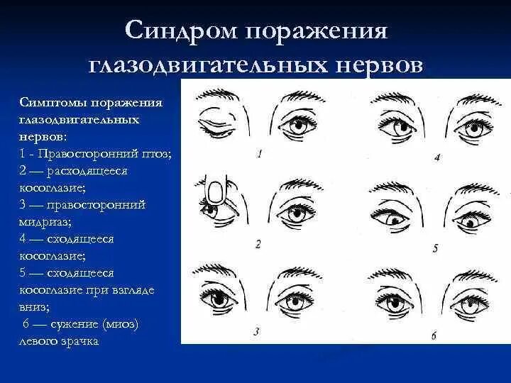 Синдром поражения глазодвигательных глазодвигательного нерва. Симптомы поражения глазодвигательных нервов. Симптомы поражения глазодвигательного нерва неврология. Симптомы периферического поражения глазодвигательного нерва.