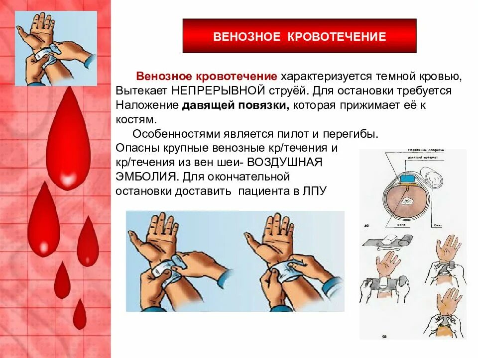 Признаки венозного кровотечения. Пример характеризующий венозное кровотечение. Пример характеризующий венозное кровотечение. Характеристика видов кровотечений. Назовите признаки венозного кровотечения.