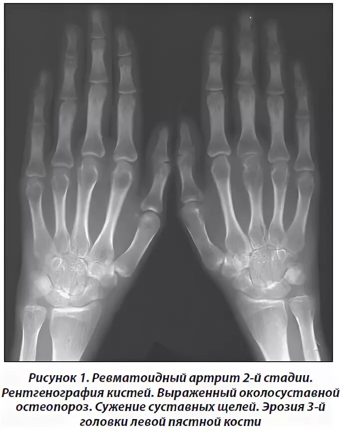 стадии ревматоидного артрита по штейнброкеру. ревматоидный артрит степени рентген. ревматоидный артрит 1 стадия на рентгене. рентген стадия 2. рентген кистей при ревматоидном артрите описание.