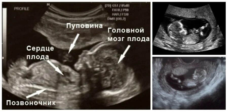 Ребенок 12 недель беременности узи
