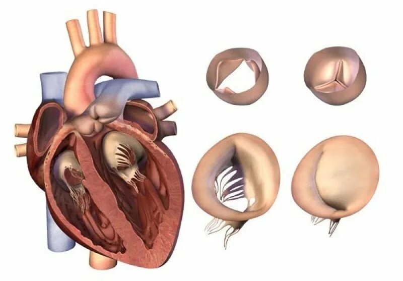 Митральный аортальный стеноз. Комбинированный сочетанный митральный порок сердца. Приобретенные митральные пороки сердца. Комбинированный митрально-аортальный порок сердца. Комбинированный порок митрального клапана.