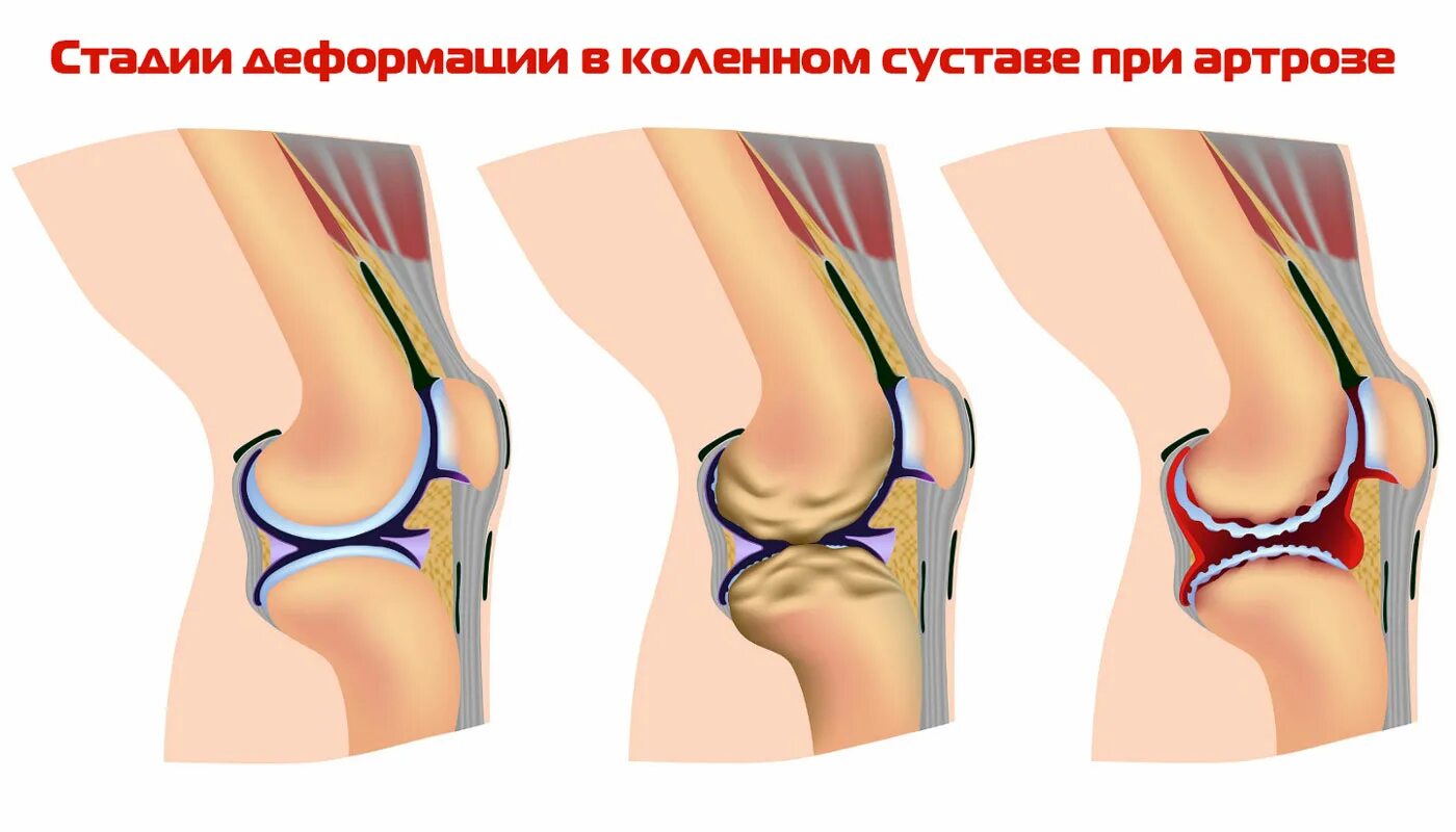 Что лучше для коленного сустава. Гонартроз коленного сустава 1. Гонартроза коленного сустава 1. Ревматоидный гонартроз коленного. Первичный гонартроз двусторонний.