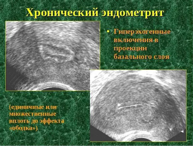 Железистая гиперплазия эндометрия узи. Гиперплазия эндометрия узи заключение. Ультразвуковые критерии гиперплазии эндометрия. Эхопризнаки эндометрия. Эхопризнаки эндометрия.