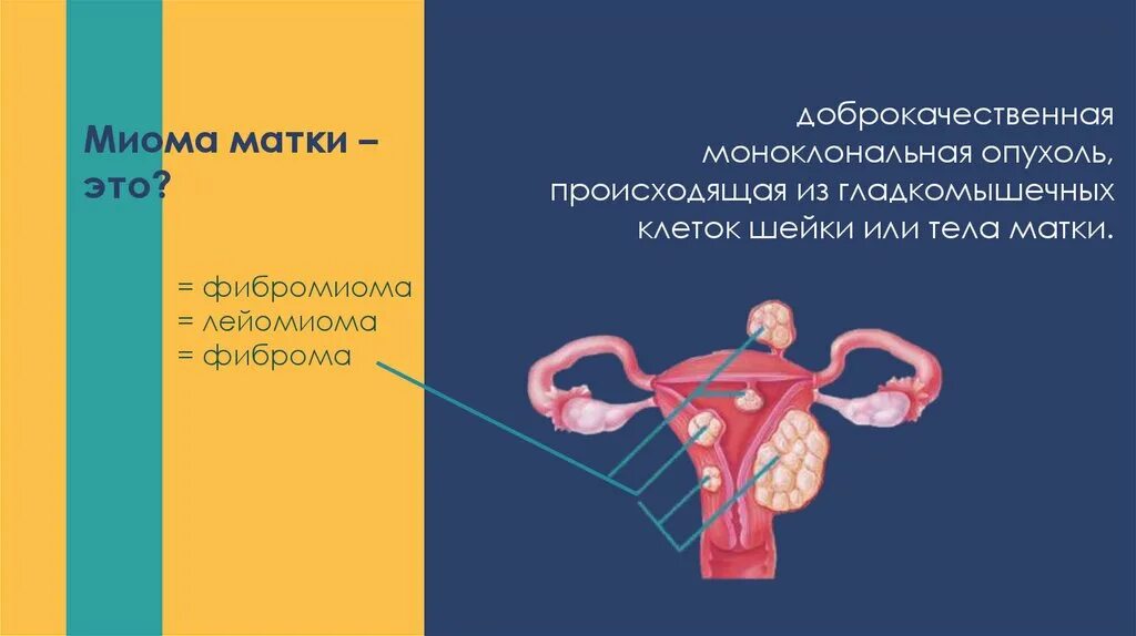 Миома матки болит живот. Расположение миоматозных узлов.